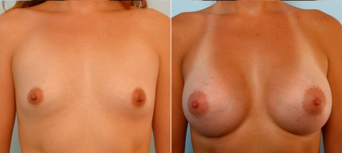 Patient 25097, Breast Augmentation before and after photos Breast Augmentation before and after photos in Houston, TX, Patient 25097