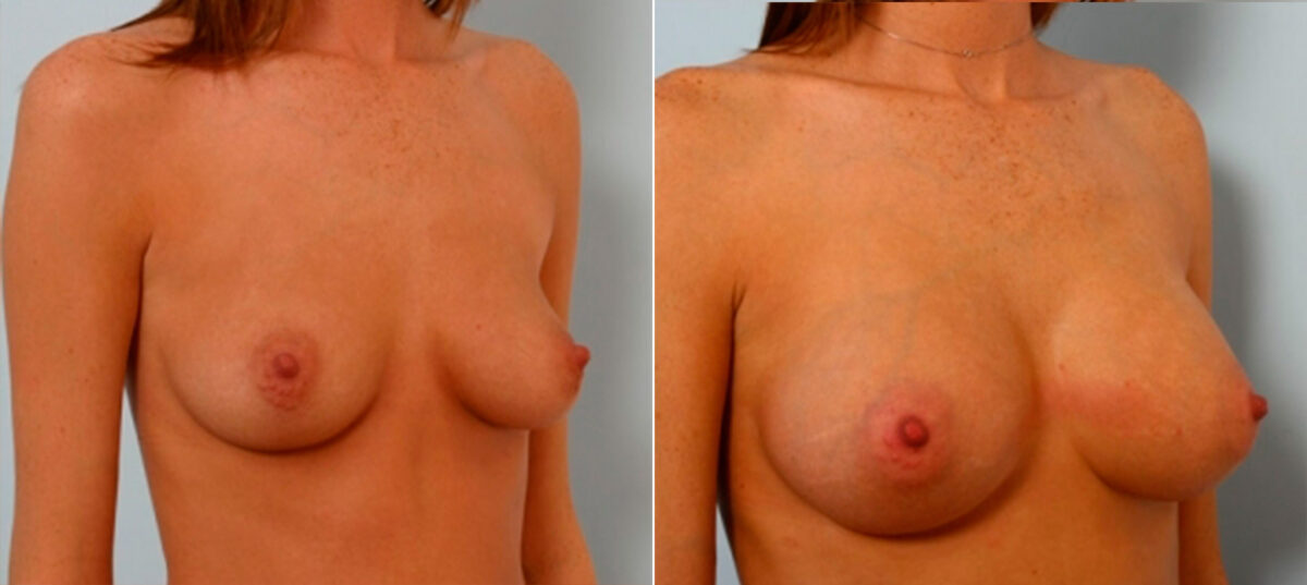 Breast Augmentation before and after photos in Houston, TX, Patient 25108
