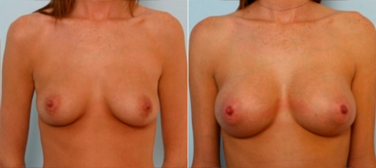 Patient 25108, Breast Augmentation before and after photos Breast Augmentation before and after photos in Houston, TX, Patient 25108