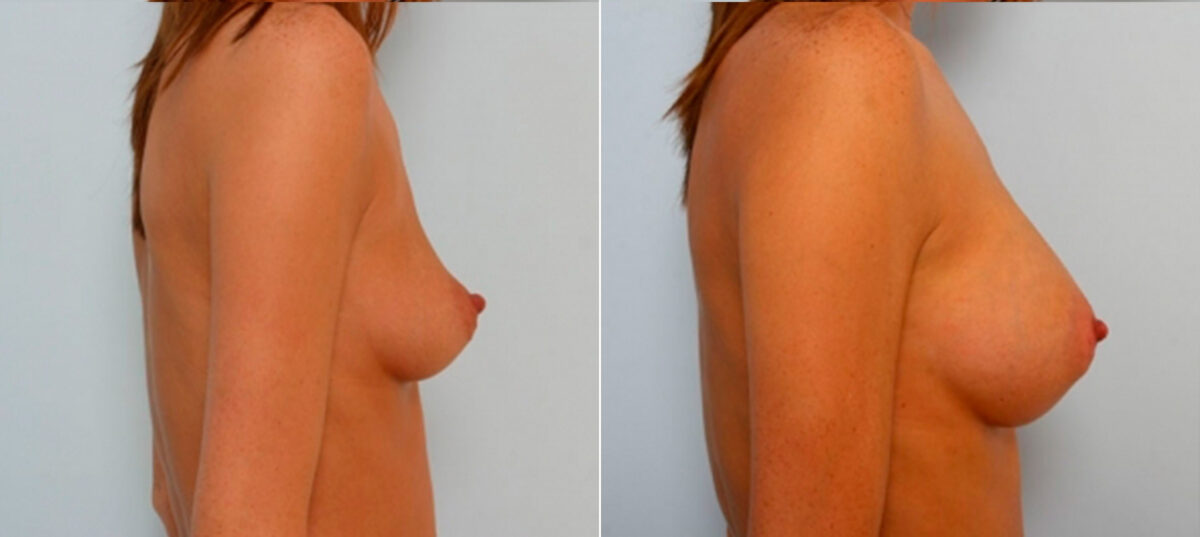 Breast Augmentation before and after photos in Houston, TX, Patient 25108