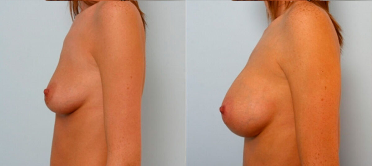 Breast Augmentation before and after photos in Houston, TX, Patient 25108