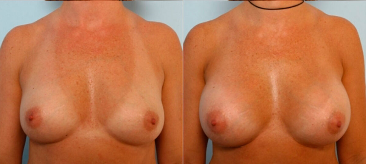 Patient 25119, Breast Augmentation before and after photos Breast Augmentation before and after photos in Houston, TX, Patient 25119