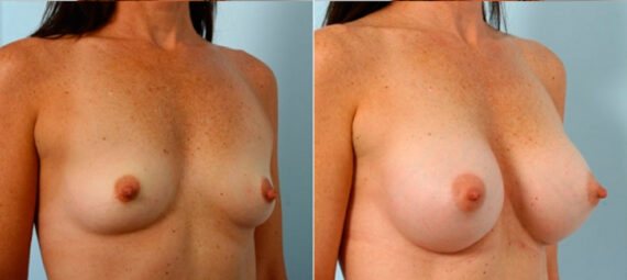 Breast Augmentation before and after photos in Houston, TX, Patient 25141