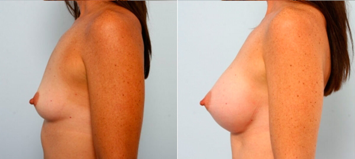 Breast Augmentation before and after photos in Houston, TX, Patient 25141