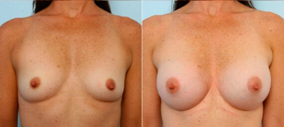 Breast Augmentation before and after photos in Houston, TX, Patient 25141