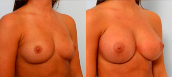 Breast Augmentation before and after photos in Houston, TX, Patient 25152