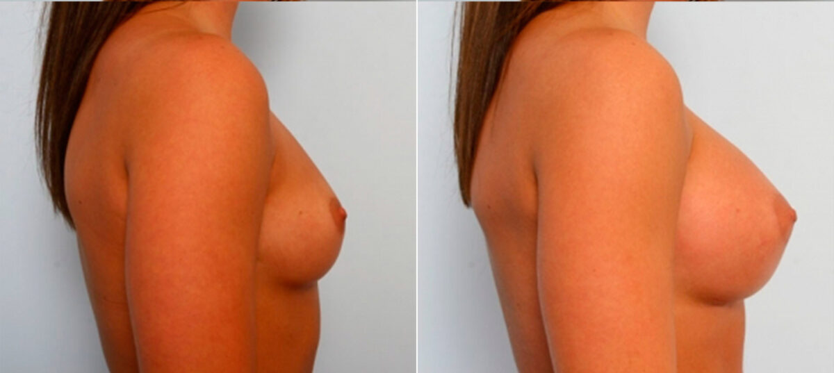 Breast Augmentation before and after photos in Houston, TX, Patient 25152