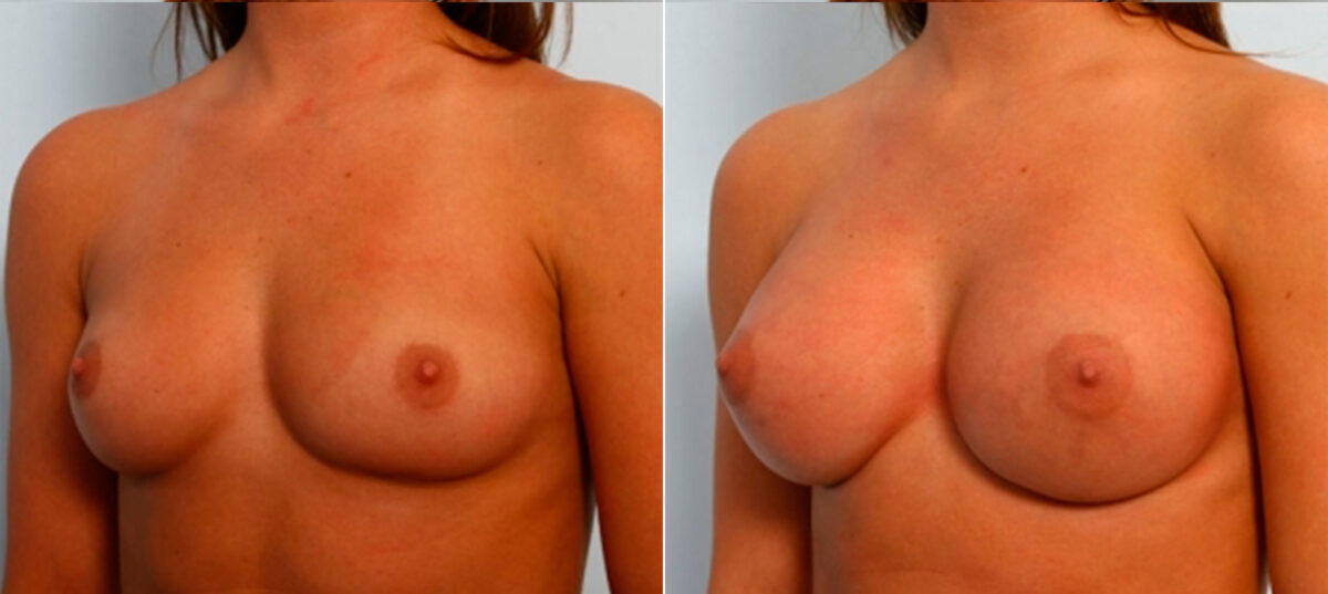 Breast Augmentation before and after photos in Houston, TX, Patient 25152