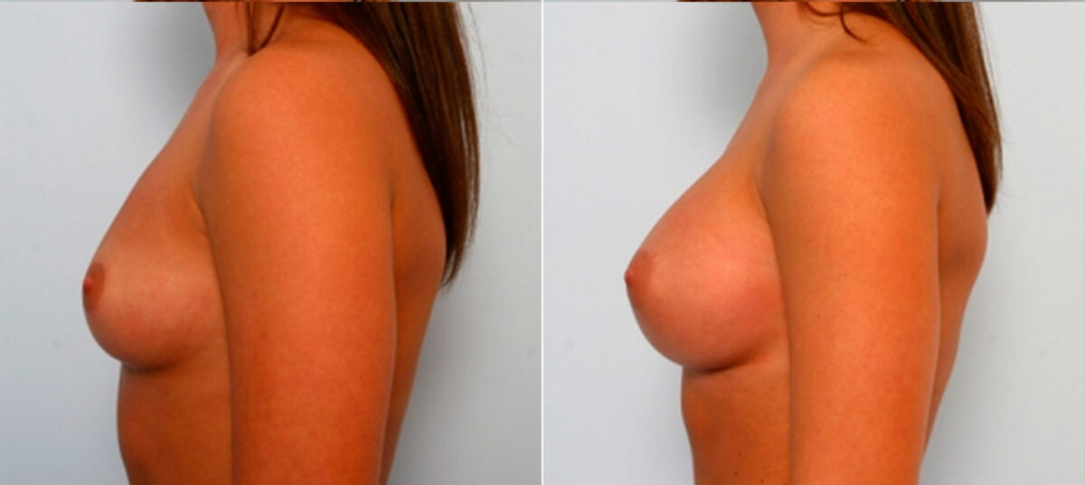Breast Augmentation before and after photos in Houston, TX, Patient 25152