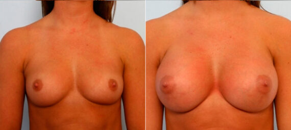 Breast Augmentation before and after photos in Houston, TX, Patient 25152