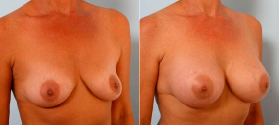 Breast Augmentation before and after photos in Houston, TX, Patient 25174