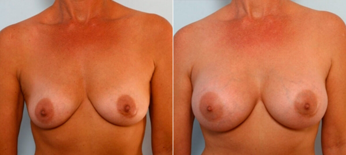 Breast Augmentation before and after photos in Houston, TX, Patient 25174