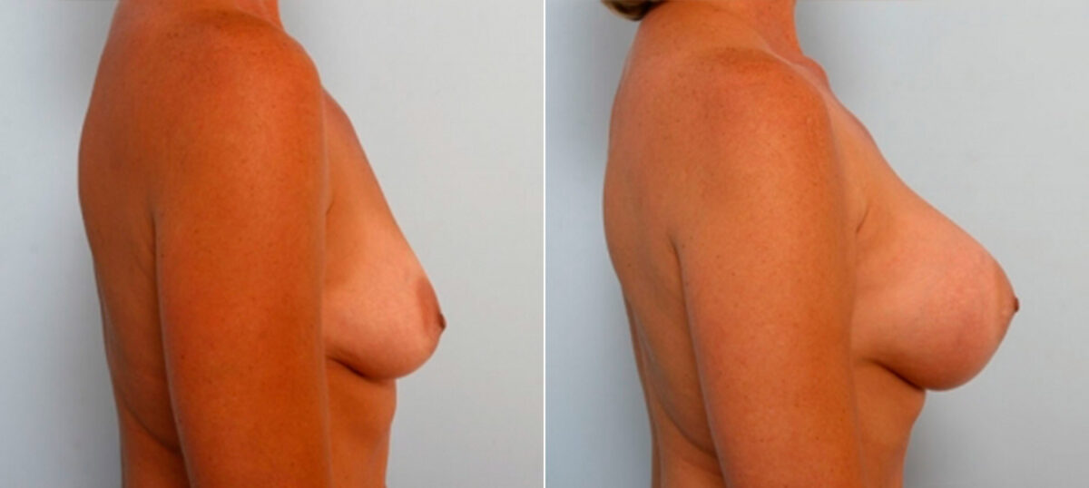 Breast Augmentation before and after photos in Houston, TX, Patient 25174
