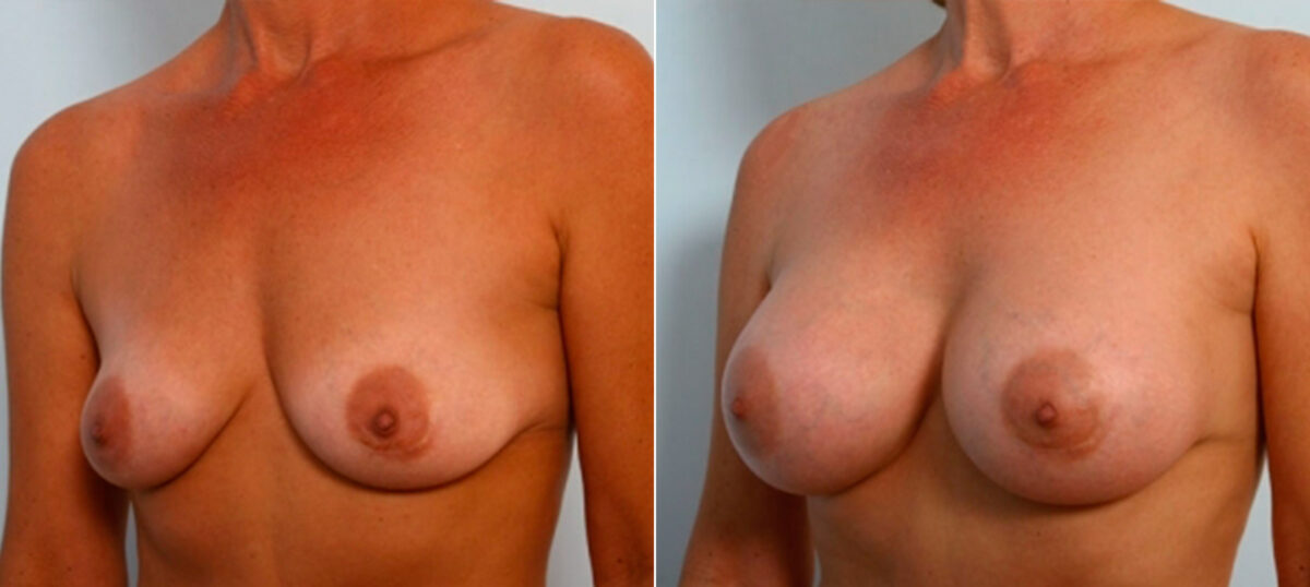 Breast Augmentation before and after photos in Houston, TX, Patient 25174