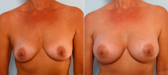 Breast Augmentation before and after photos in Houston, TX, Patient 25174