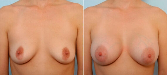 Breast Augmentation before and after photos in Houston, TX, Patient 25185