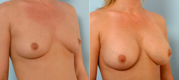 Breast Augmentation before and after photos in Houston, TX, Patient 25196