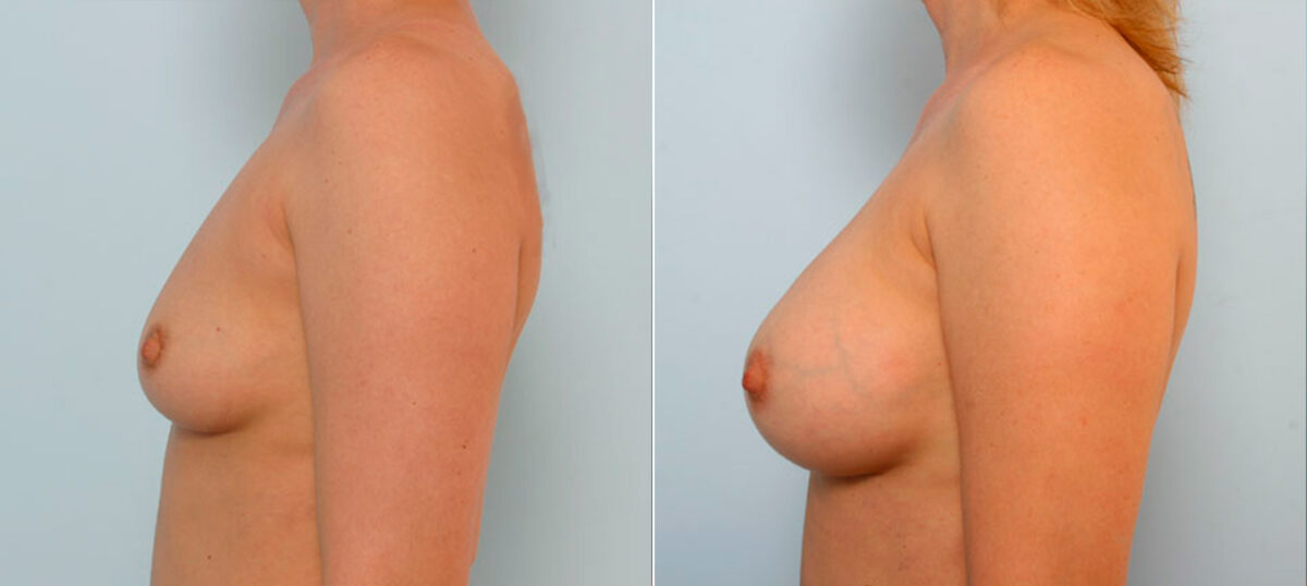 Breast Augmentation before and after photos in Houston, TX, Patient 25196