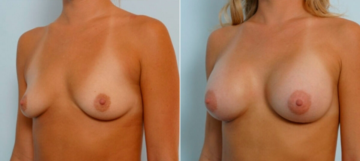 Breast Augmentation before and after photos in Houston, TX, Patient 25198