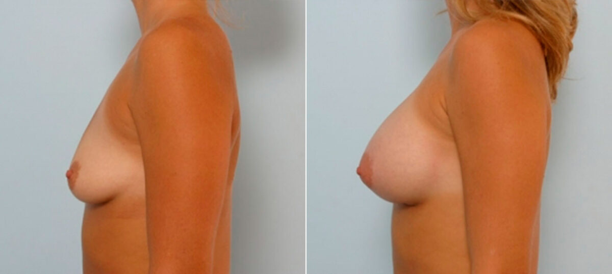 Breast Augmentation before and after photos in Houston, TX, Patient 25198