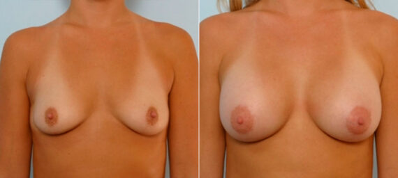 Breast Augmentation before and after photos in Houston, TX, Patient 25198