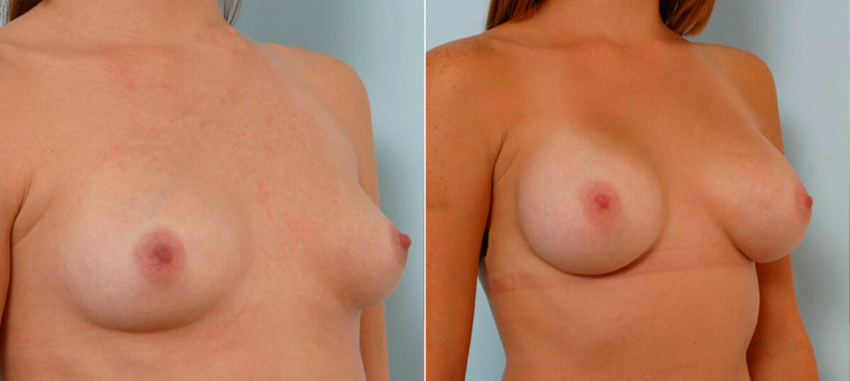 Patient 25220, Breast Augmentation before and after photos Breast Augmentation before and after photos in Houston, TX, Patient 25220