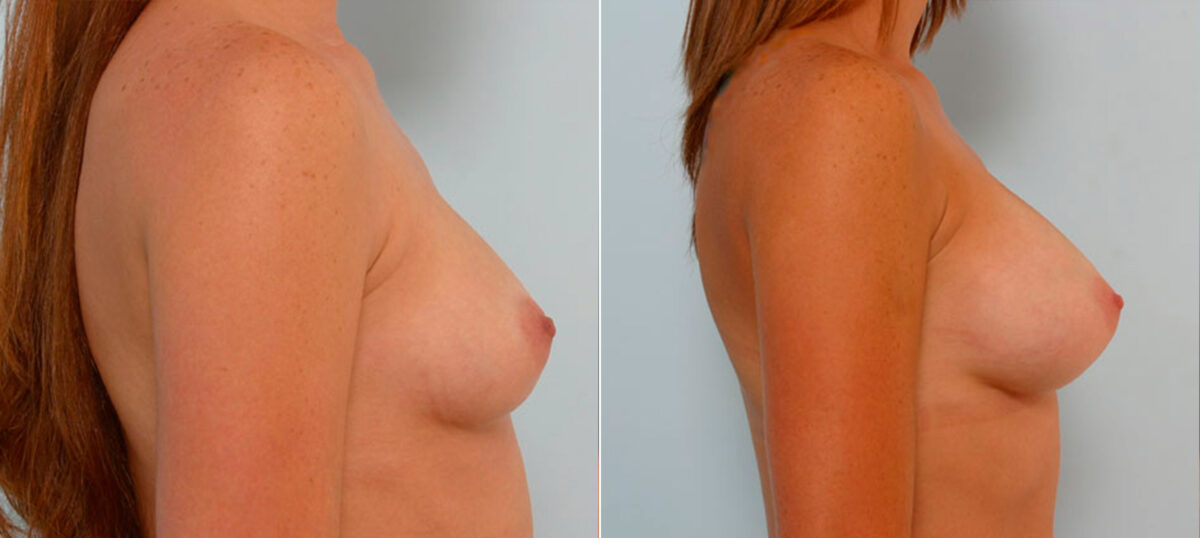 Breast Augmentation before and after photos in Houston, TX, Patient 25220