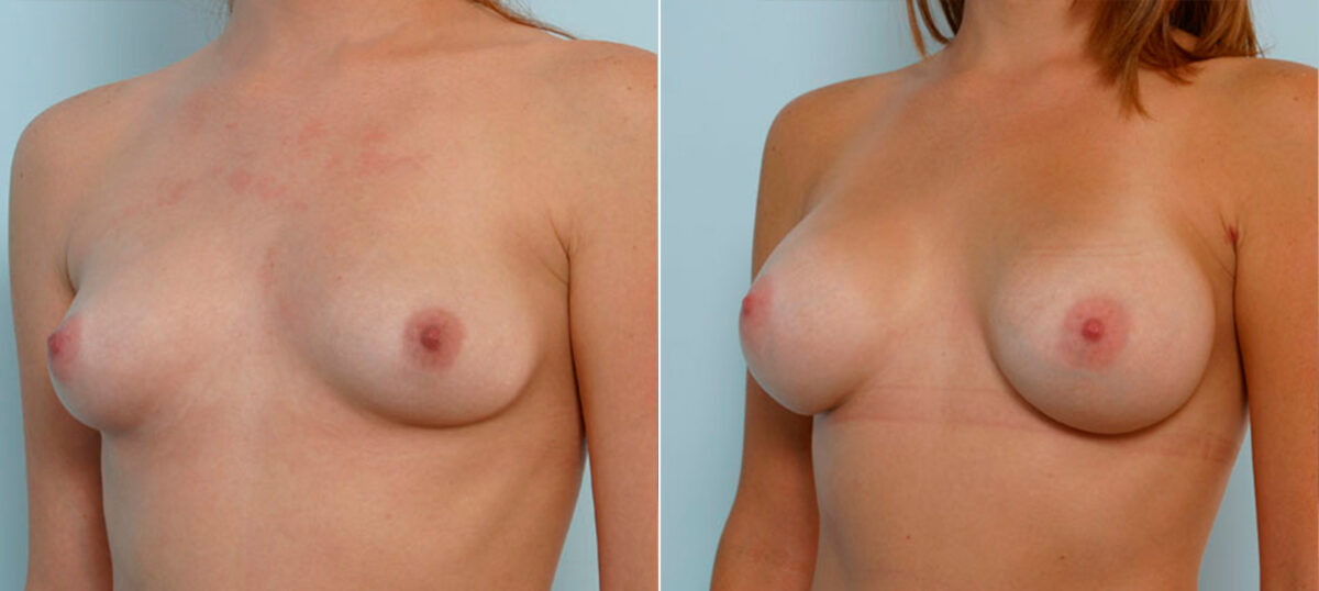 Breast Augmentation before and after photos in Houston, TX, Patient 25220