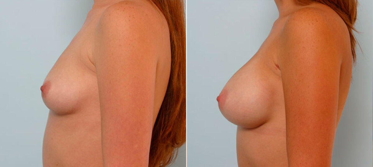 Breast Augmentation before and after photos in Houston, TX, Patient 25220