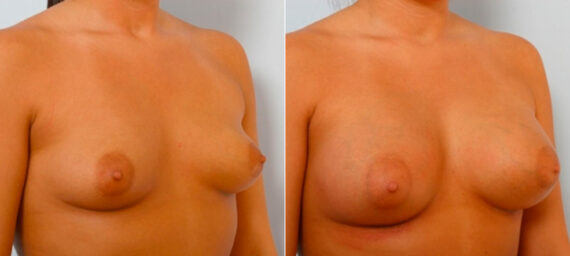 Breast Augmentation before and after photos in Houston, TX, Patient 25231