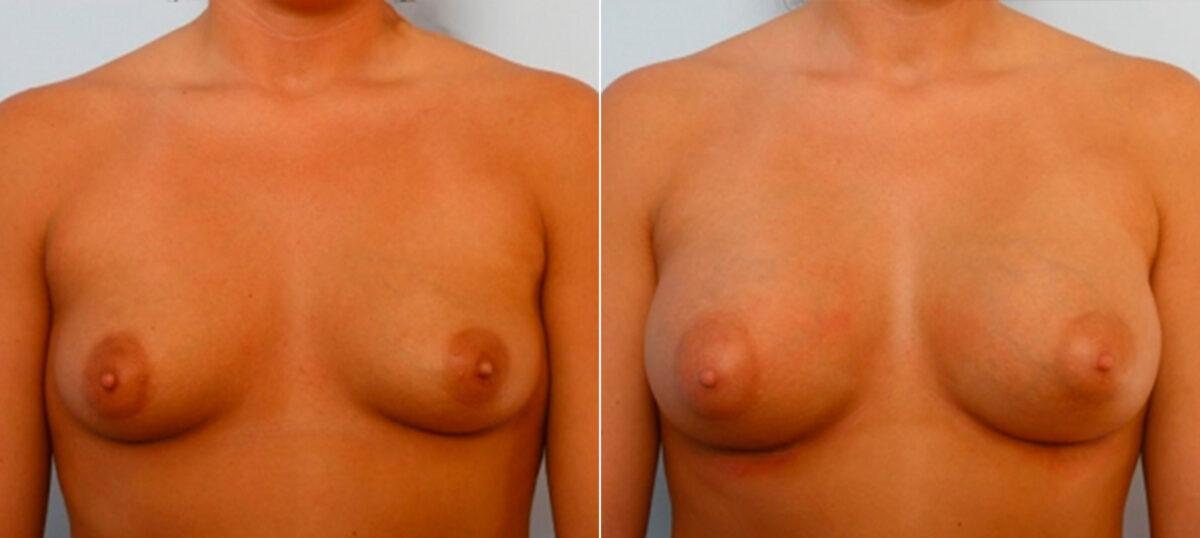 Breast Augmentation before and after photos in Houston, TX, Patient 25231