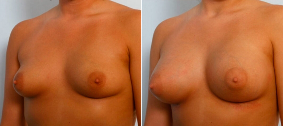 Breast Augmentation before and after photos in Houston, TX, Patient 25231