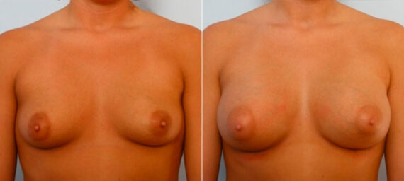 Breast Augmentation before and after photos in Houston, TX, Patient 25231