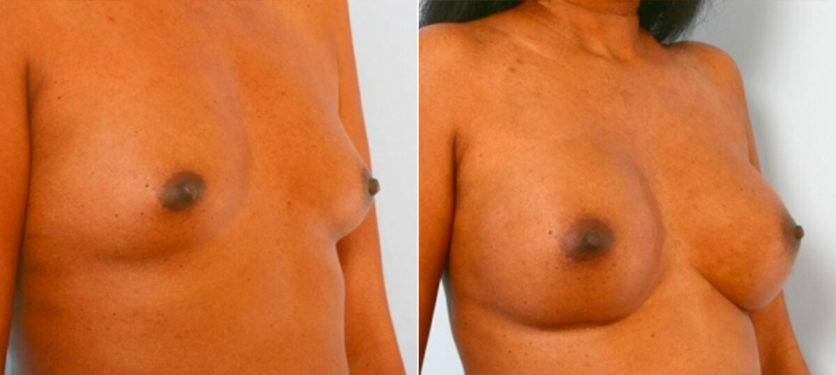 Breast Augmentation before and after photos in Houston, TX, Patient 25253