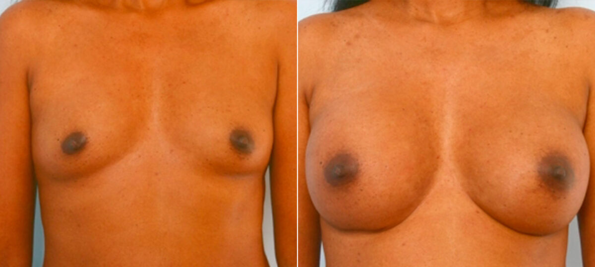 Breast Augmentation before and after photos in Houston, TX, Patient 25253