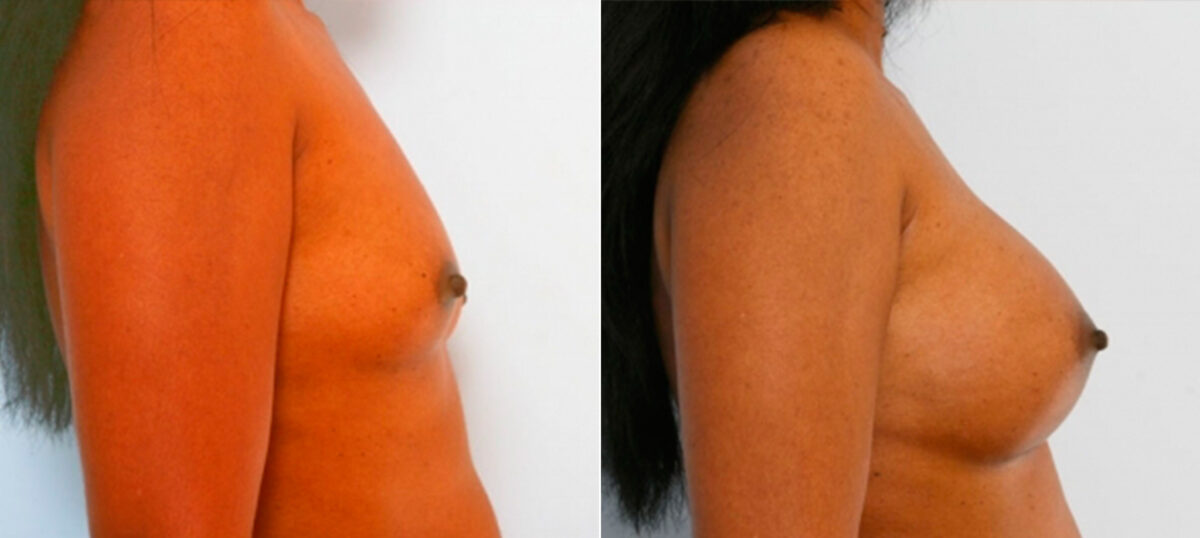 Breast Augmentation before and after photos in Houston, TX, Patient 25253