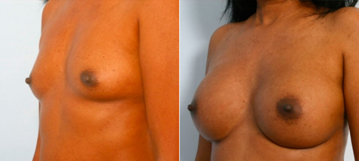 Breast Augmentation before and after photos in Houston, TX, Patient 25253