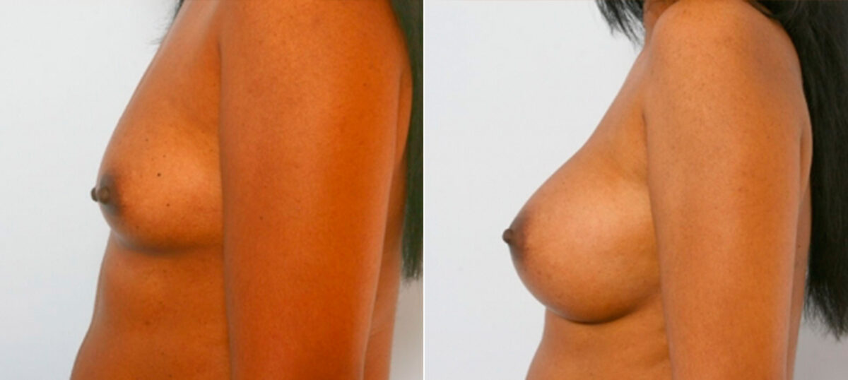 Breast Augmentation before and after photos in Houston, TX, Patient 25253