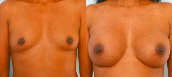 Breast Augmentation before and after photos in Houston, TX, Patient 25253