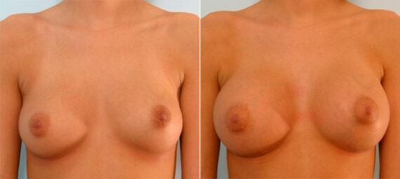 Breast Augmentation before and after photos in Houston, TX, Patient 25264