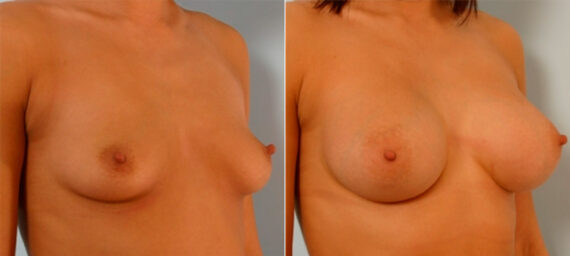 Breast Augmentation before and after photos in Houston, TX, Patient 25275