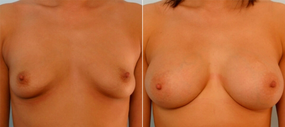 Breast Augmentation before and after photos in Houston, TX, Patient 25275