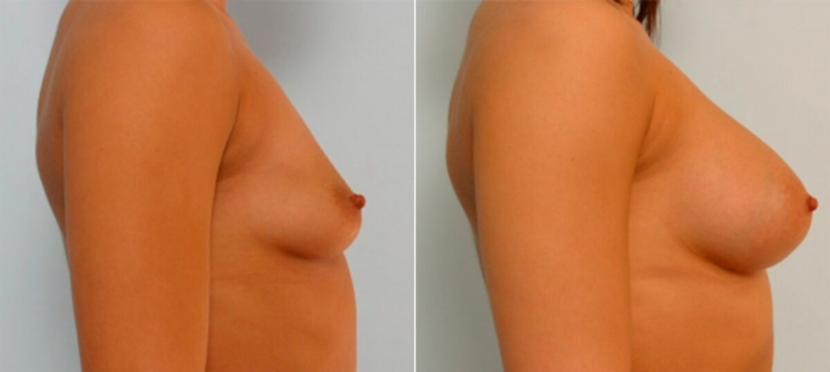 Breast Augmentation before and after photos in Houston, TX, Patient 25275