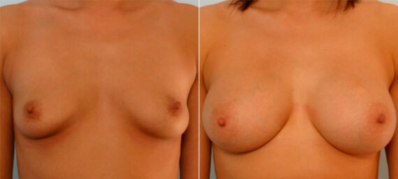 Breast Augmentation before and after photos in Houston, TX, Patient 25275