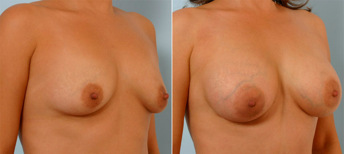 Breast Augmentation before and after photos in Houston, TX, Patient 25293
