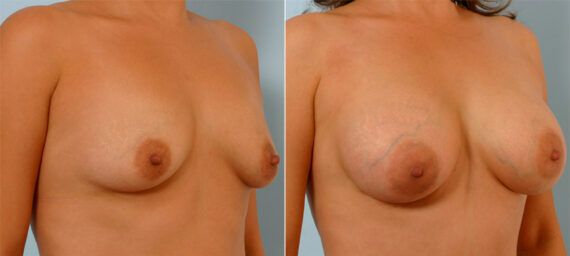 Breast Augmentation before and after photos in Houston, TX, Patient 25293