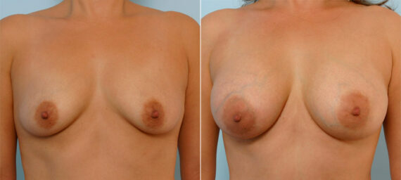 Breast Augmentation before and after photos in Houston, TX, Patient 25293