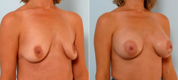 Breast Augmentation before and after photos in Houston, TX, Patient 25300