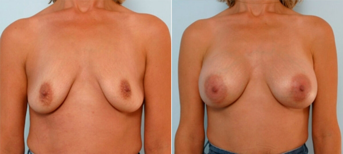 Breast Augmentation before and after photos in Houston, TX, Patient 25300