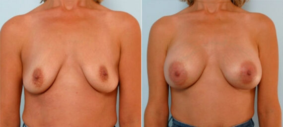 Breast Augmentation before and after photos in Houston, TX, Patient 25300